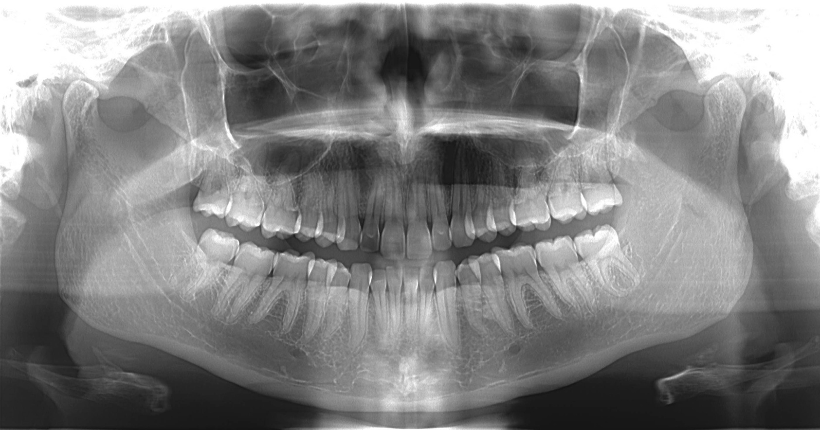 3D Dental Cone Beam CT Scans and 2D OPG (Orthopantomagram), Dental X-Ray